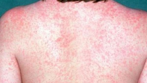 measles on back